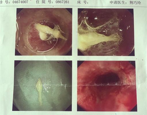 喉镜看鱼刺能检查到食道吗？能发现哪些问题？